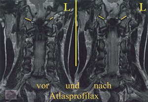 Atlas pre i posle